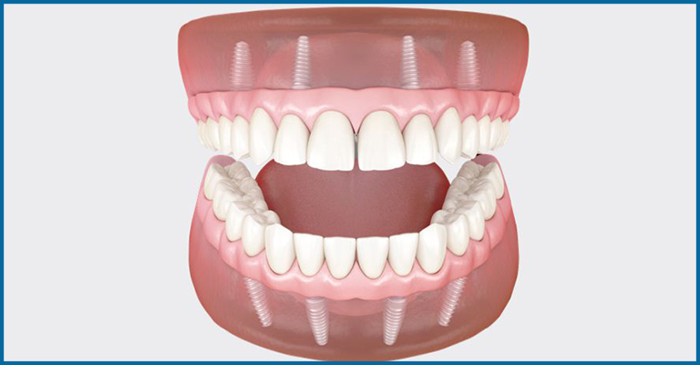 Why implant supported dentures are worth consideration