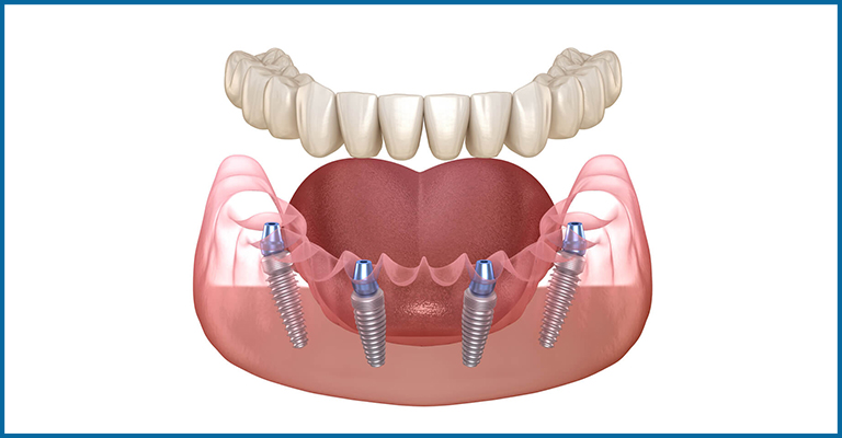 All on four implants