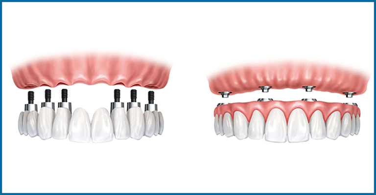 All on six implants supported dentures