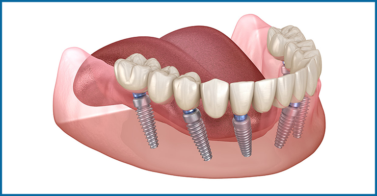 All on six dental implants fixed denture
