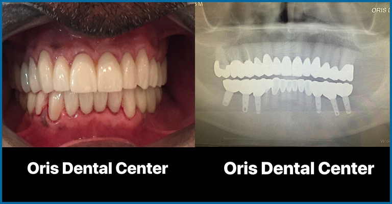 full arch X-ray