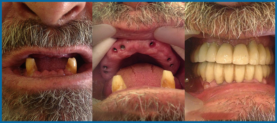 full arch patient result