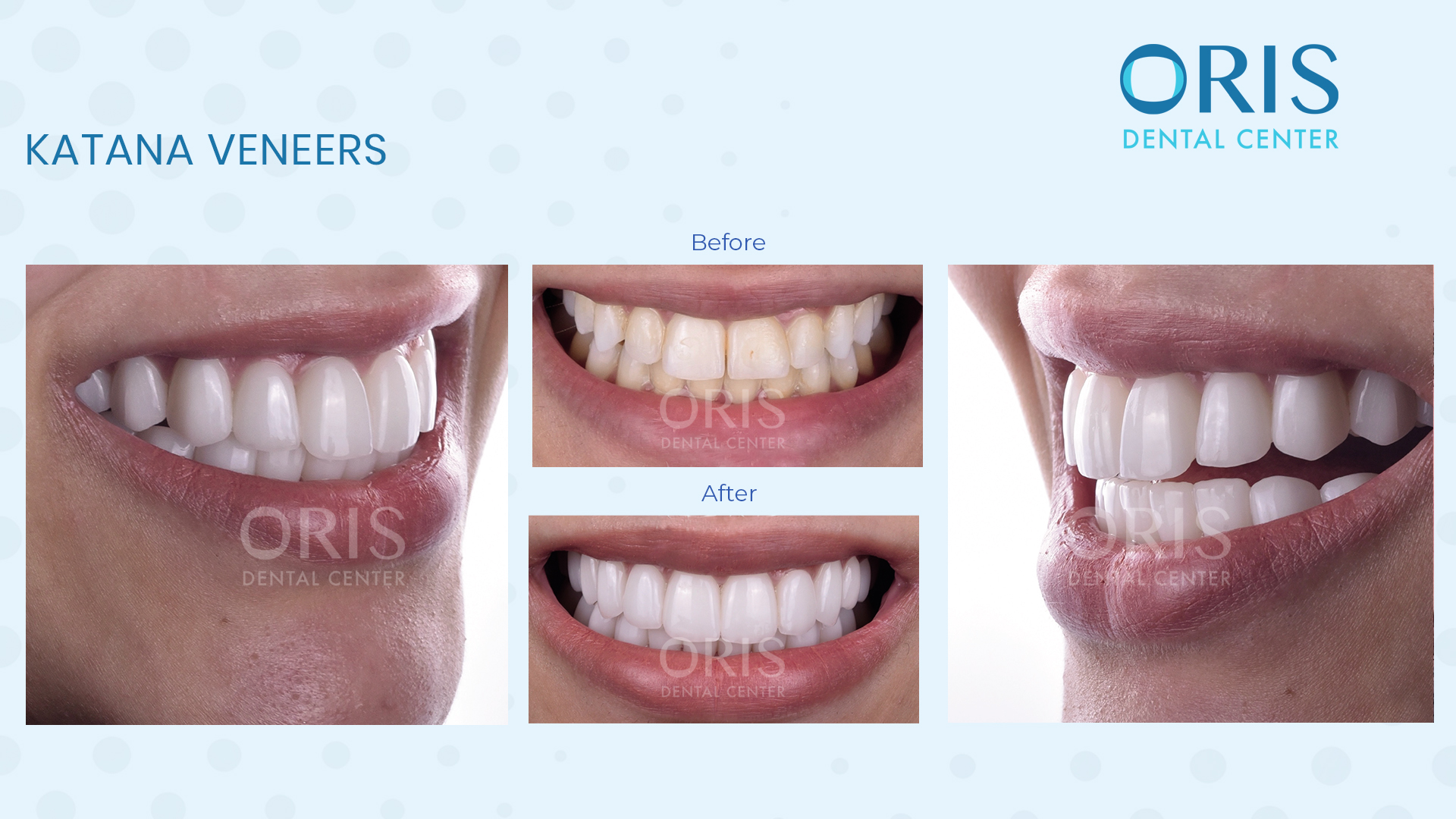 Zirconia translucent veneers