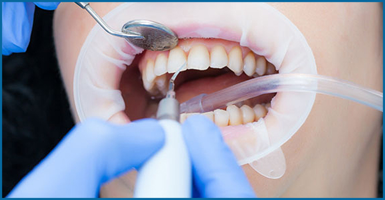 dentist cleaning patient teeth