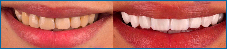 women smiles before and after Veneers treatment