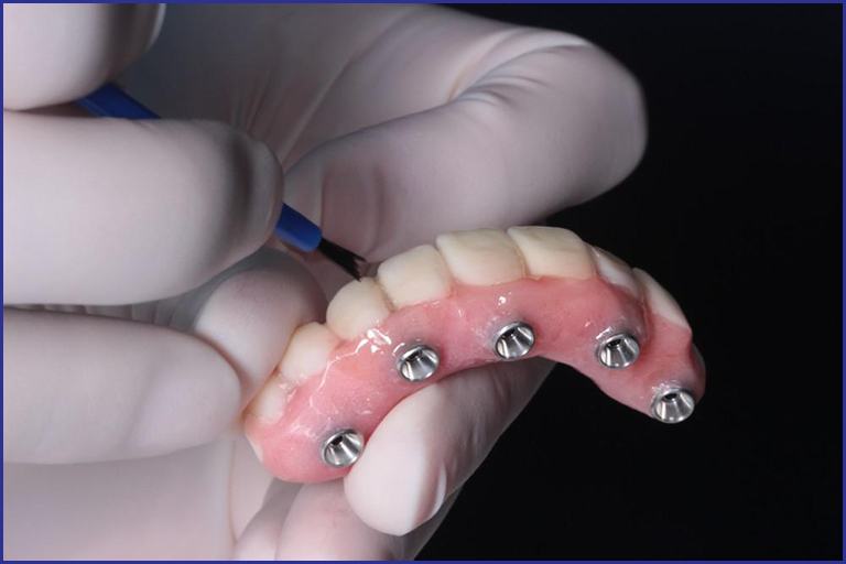 dental implant dentures