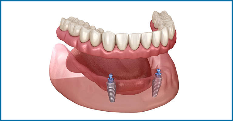 two implant supported denture