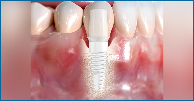 dental implant fixed