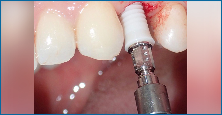 drilling for dental implants surgery
