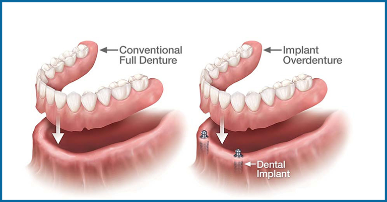 conventional full denture and implant overdenture comparison