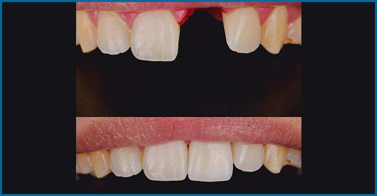 dental implants real image