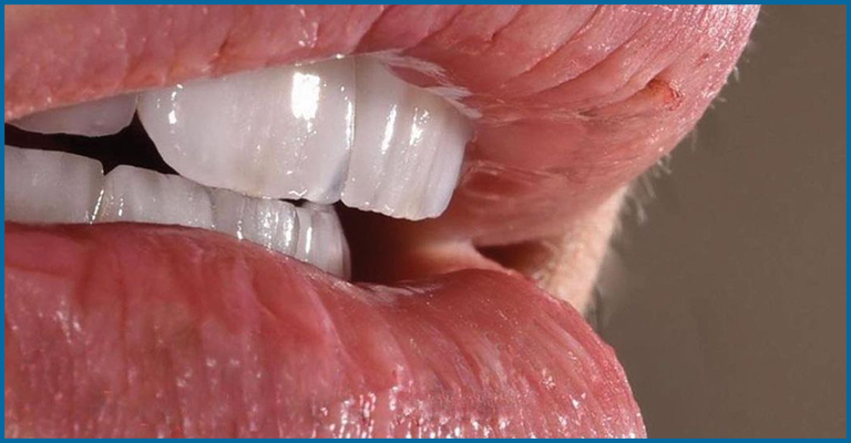 Katana zirconia veneers
