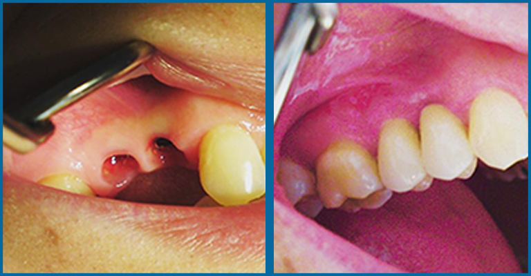drilled area for dental implants