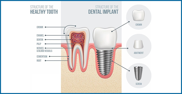 dental implants components