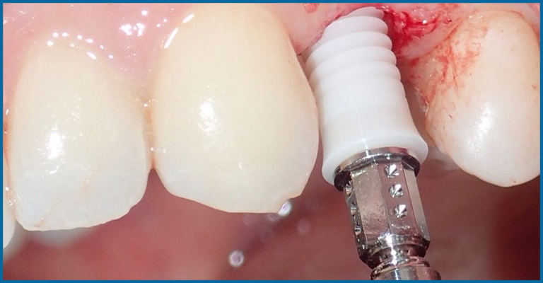drilling to fix dental implants
