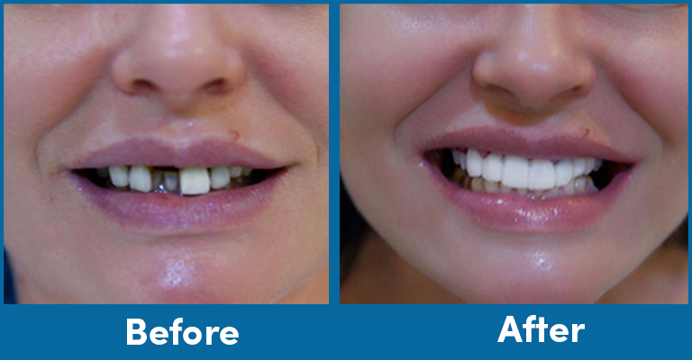 same day implants before after patient