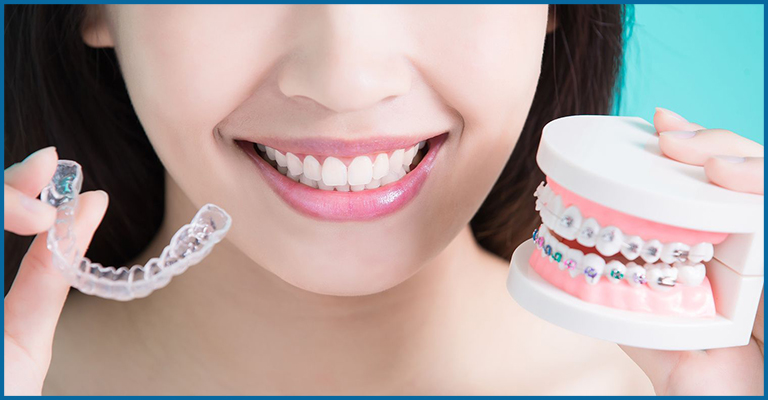 braces vs invisalign