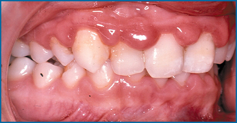 gum disease in child