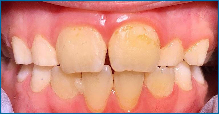 Yellow teeth