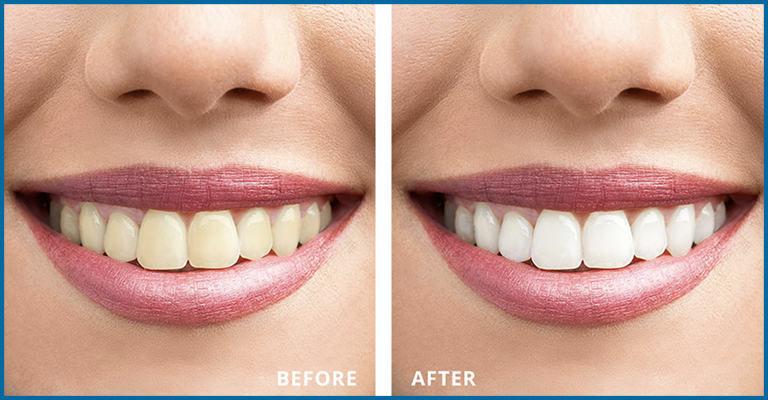 teeth whitening before and after