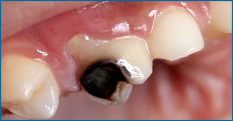 Decayed kids tooth