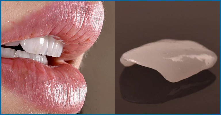ceramic veneers