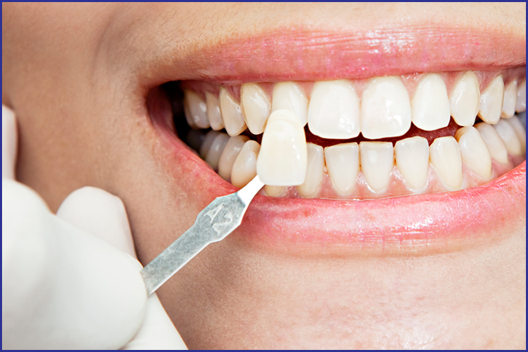 Dental veneers for multiple concerns