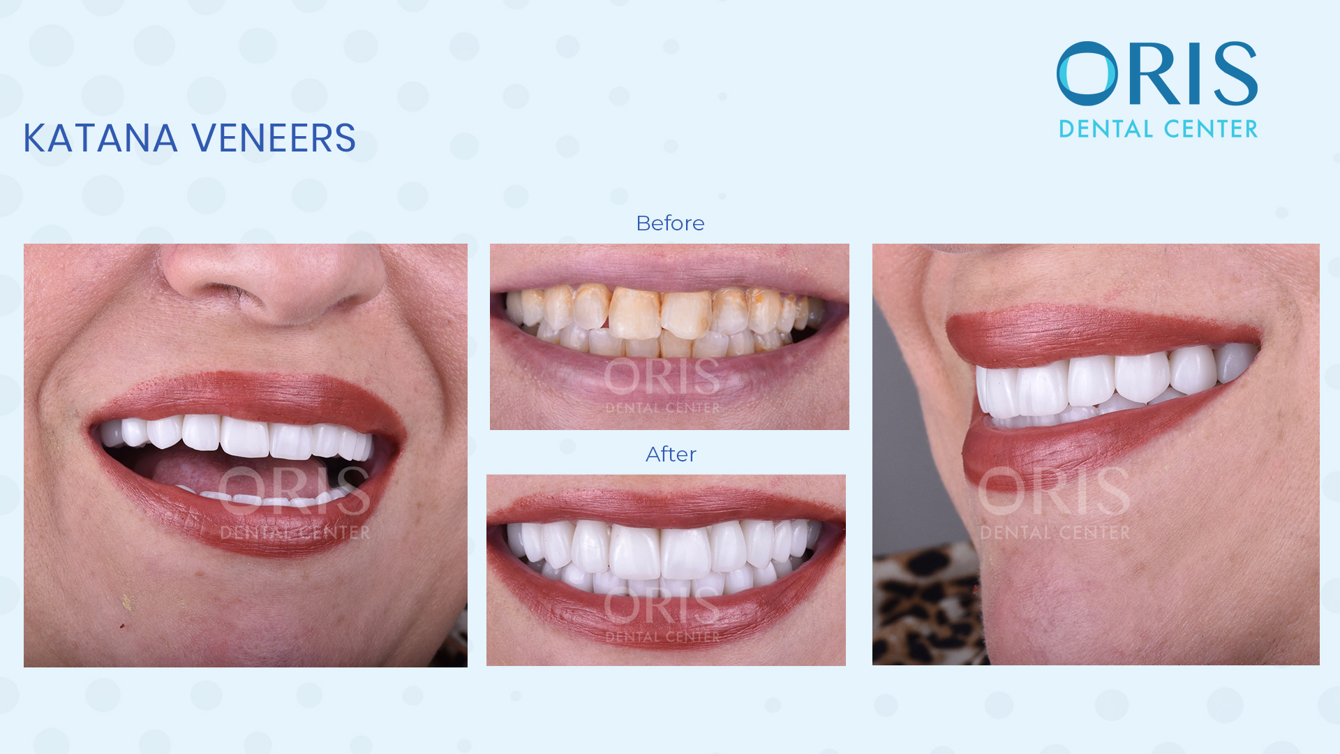 katana veneers in dubai