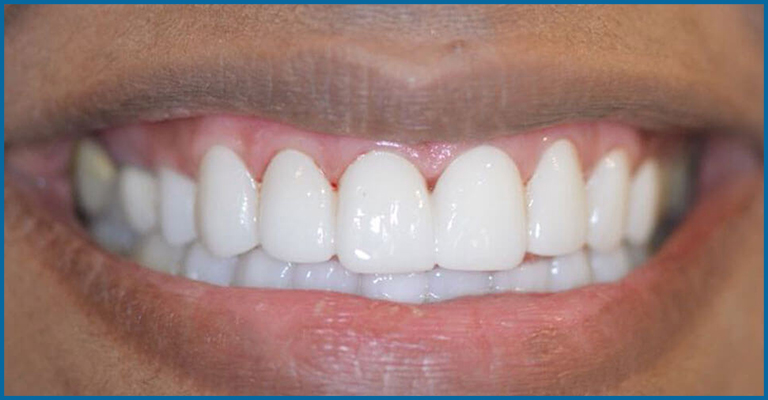 dental ceramic veneers