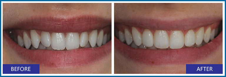 veneers before and after