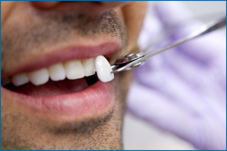 dental veneers matching tooth