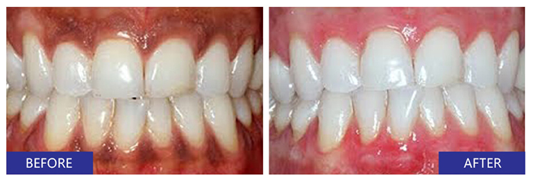 gum whitening before after