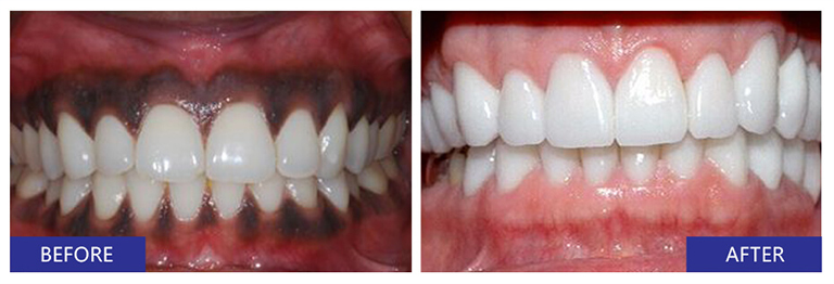 black pigmentation of gums