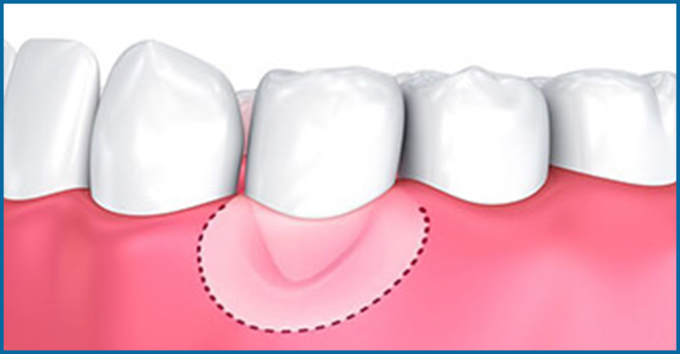 Gum depigmentation