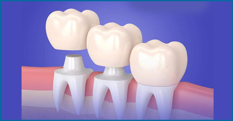 processing dental crowns
