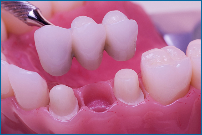 dental crown for broken teeth