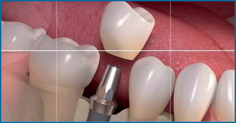 dental crown fixing