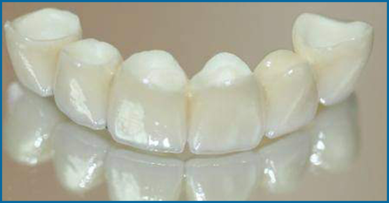dental crown