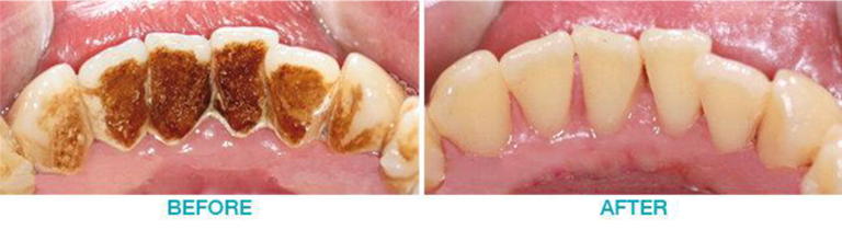 plaques before and after