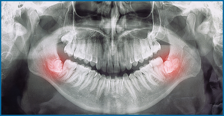 X RAY of wisdom tooth