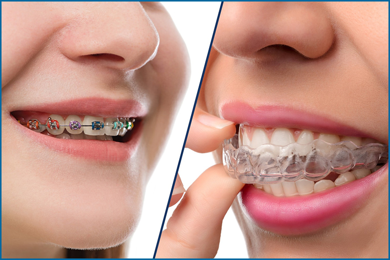 traditional vs invisible braces