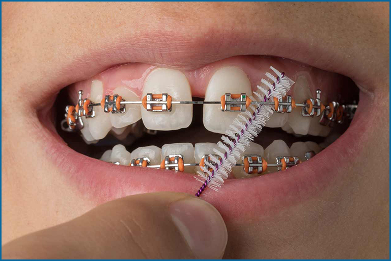 cleaning braces