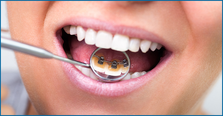 Lingual Braces