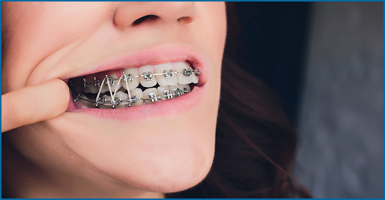 Metal braces