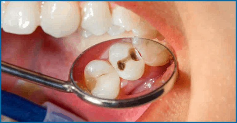 cavity in dentist lens