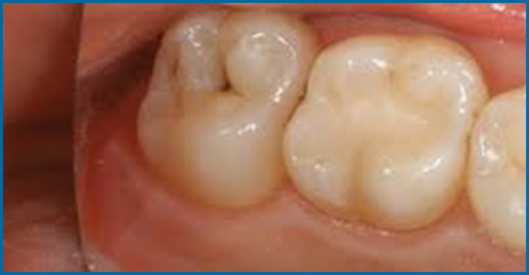 occlusal surface of teeth
