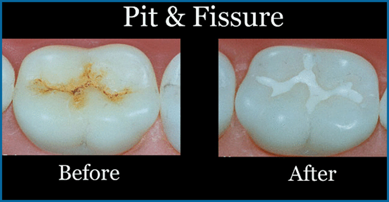 before and after pits and fissures