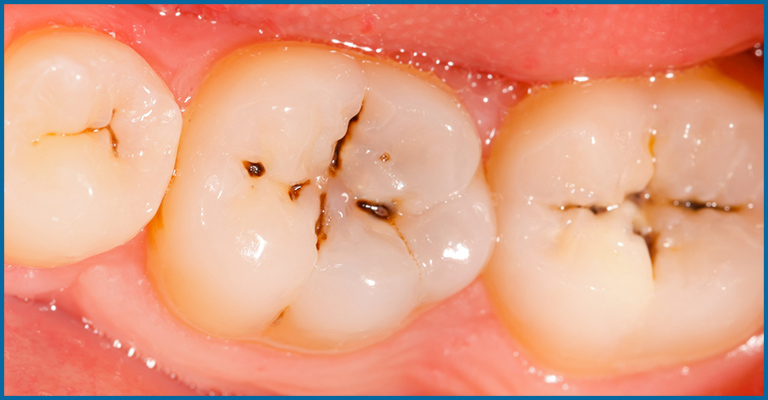 pits and fissures in teeth