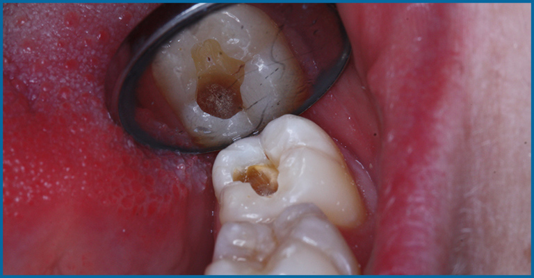 DECAYED TOOTH
