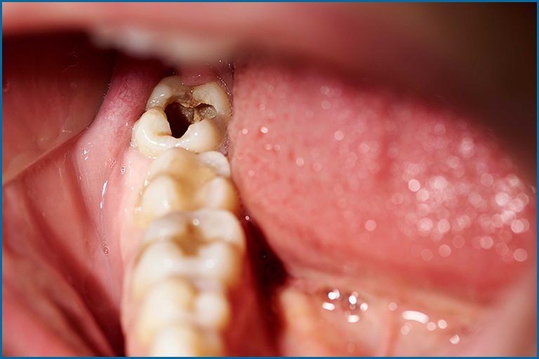 Benefits of placing Immediate dental implants